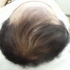 AGA治療の考えをお話ししました。（動画）